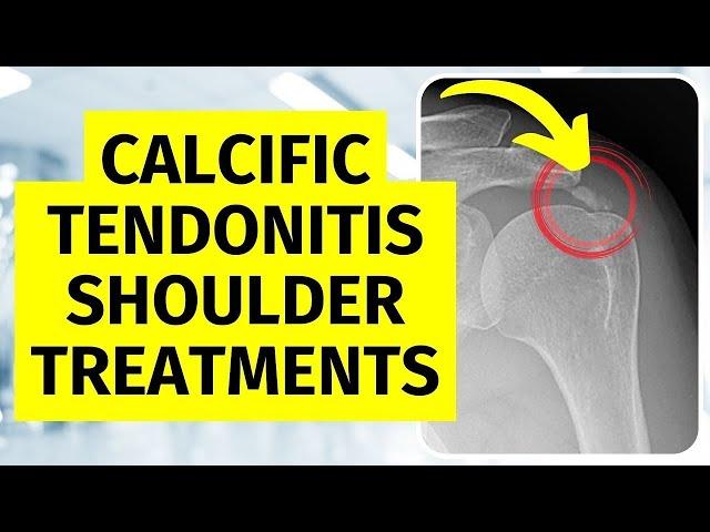 Calcific Tendonitis Shoulder Treatments Without Surgery