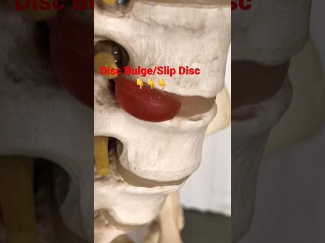 Lower back pain | L4-L5, L5-S1 Problem | Slip disc, Disc Bulge, Sciatica #shorts