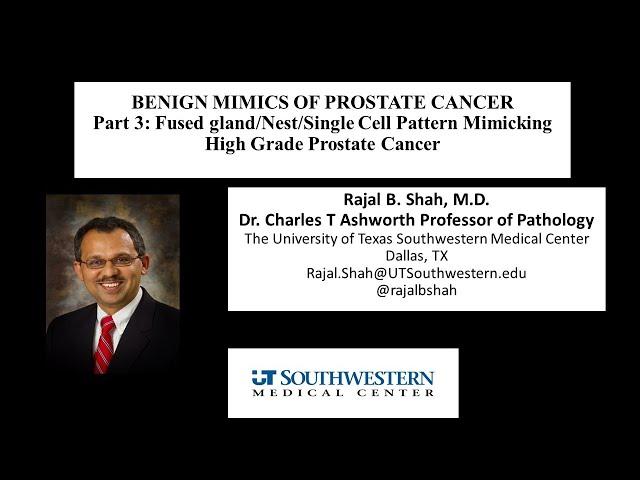 A Dummies Guide to Benign Mimics of Prostate Cancer: Part 3 Mimics of High grade cancer