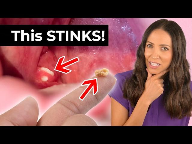 Tonsil Stones: The Hidden Cause of Bad Breath!