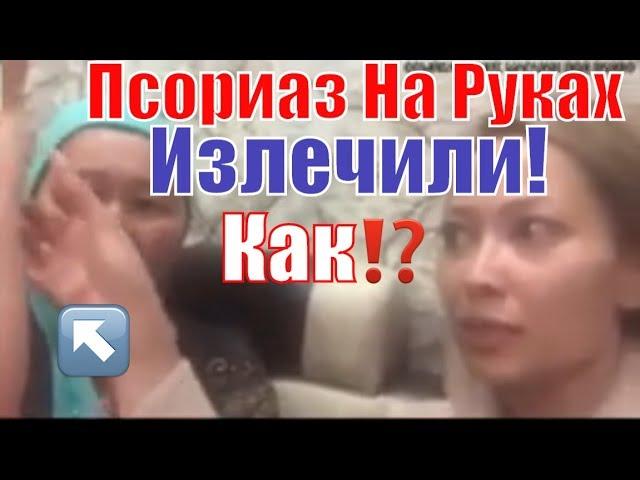 Как Лечить Псориаз На Руках-Смотрите!