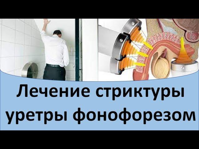 Лечение стриктуры уретры фонофорезом