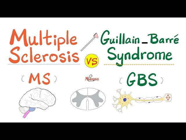 Multiple Sclerosis (MS) vs. Guillain-Barré Syndrome (GBS)- Causes, Symptoms, Diagnosis & Treatment