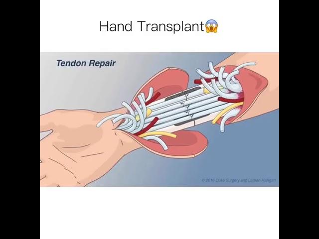 Hand Transplant