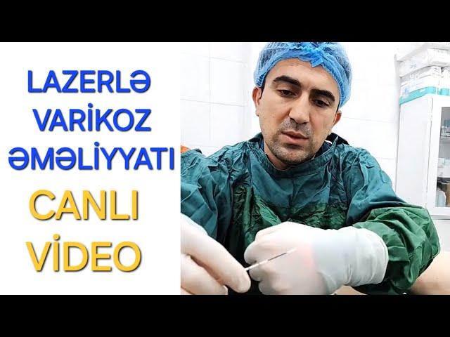 endovenoz lazer ablasiya varikoz damar emeliyyati fleboloq damar cerrahi ismayil esgerov total EVLA