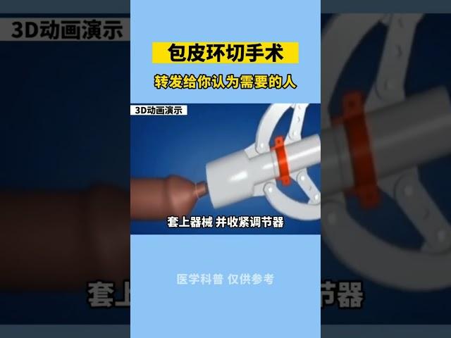 alat sunat dari jepang