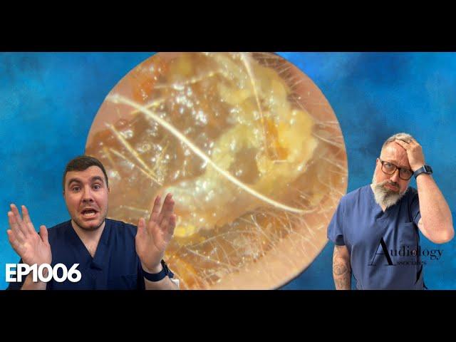 This Earwax Removal Is Unbelievable - EP1006