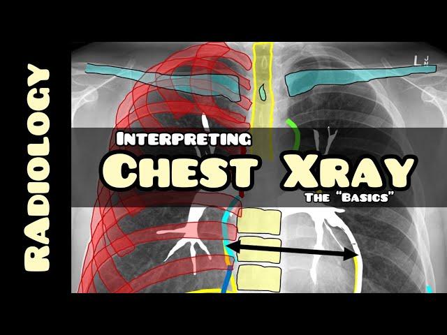 Reading a chest X-ray | Radiology