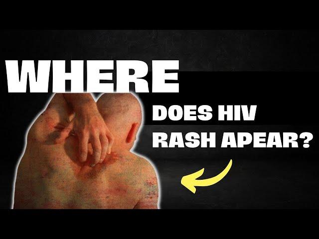 Where Does Hiv Rash Apear ?