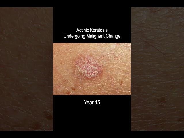 Skin Cancer Development Time Lapse (Normal to Squamous Cell Carcinoma Over 25 Years)