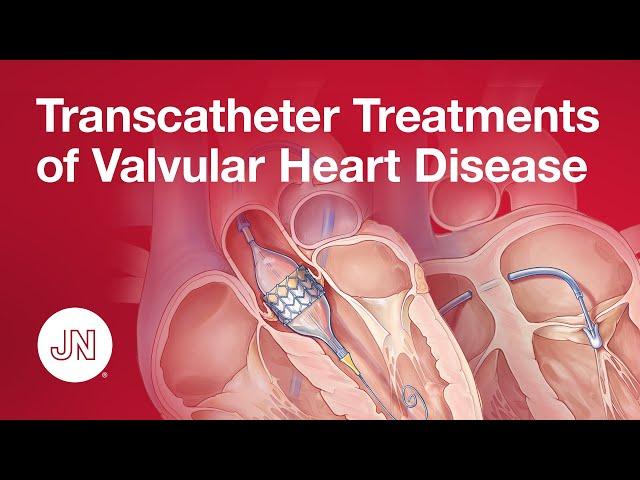 Transcatheter Treatments of Valvular Heart Disease