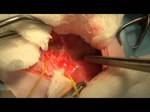 Surgical treatment of the vascular ring pathology