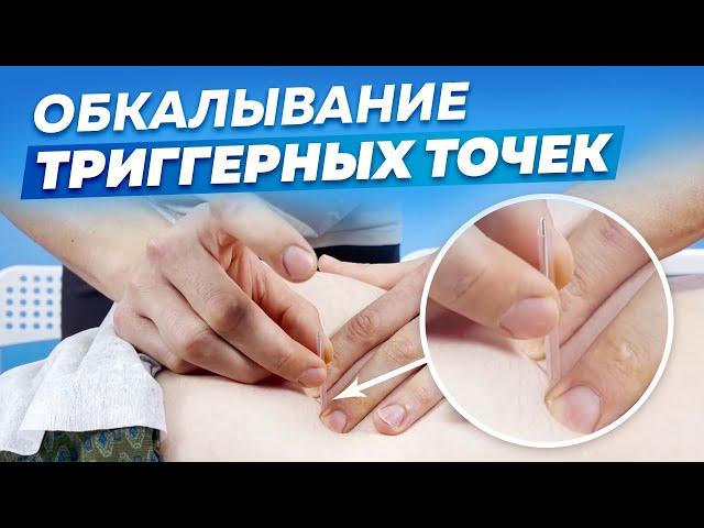 Все про ОБКАЛЫВАНИЕ Триггерных Точек