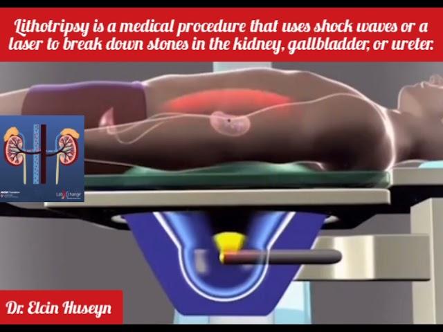 Lithotripsy is a medical procedure that uses shock waves or a laser to break down stones in the body