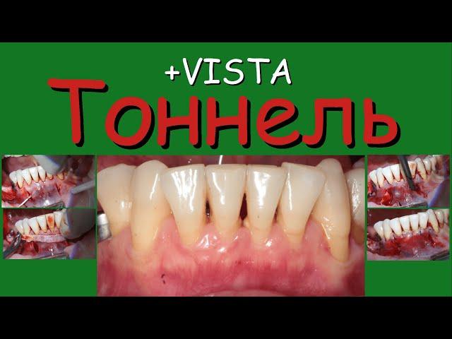 Тоннель и VISTA.