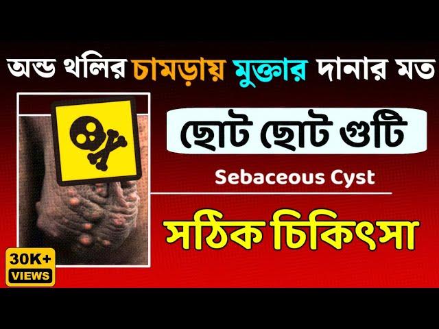 অন্ড থলির চামড়ায় টিউমার||Sebaceous cyst on scrotum||অন্ডকোষ গুটিকা সঠিক চিকিৎসা