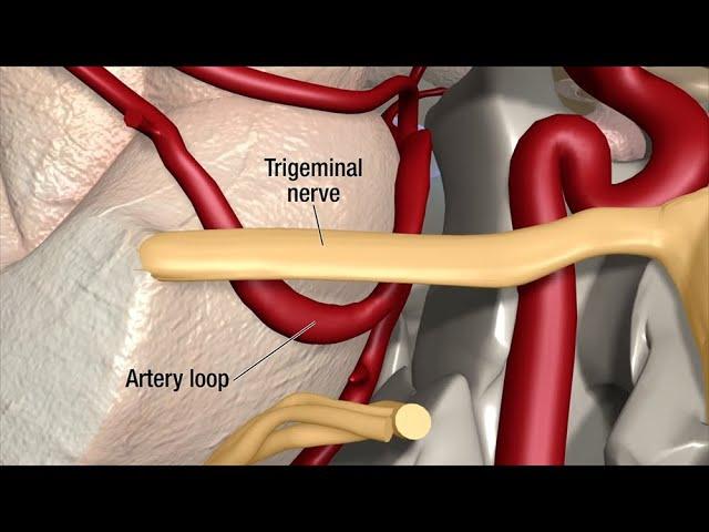 Treatment for Trigeminal Neuralgia: UCSF Neurosurgery