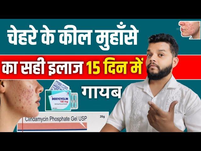 कील मुहाँसे 15 दिन मे गायब | Best Treatment For Acne And Pimples