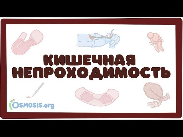 Острая кишечная непроходимость (хирургия лекция) Osmosis