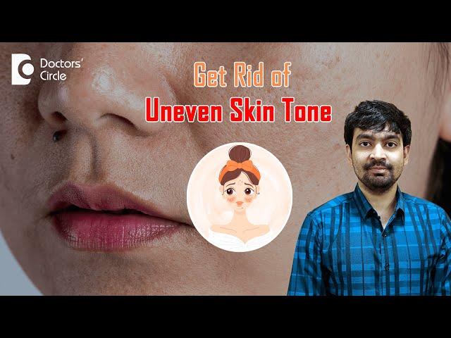 What is Uneven Skin Tone? 3 Ways to Get Rid of It #unevenskintone -Dr.Rajdeep Mysore|Doctors' Circle