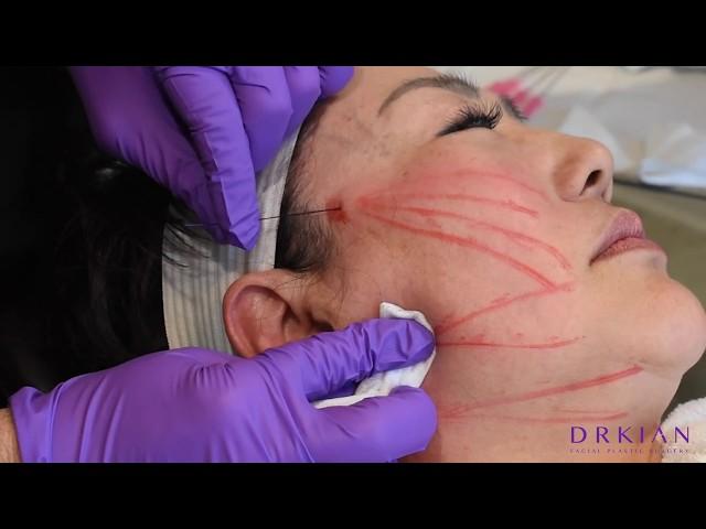 PDO Thread Lift: The Non-Surgical "Lunch-Time" Facelift with Dr. Kian Karimi