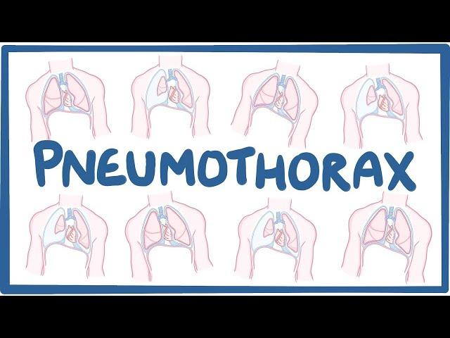 Pneumothorax - causes, symptoms, diagnosis, treatment, pathology