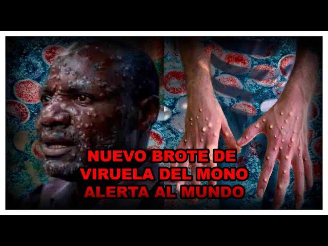 LA OMS EN ALERTA ANTE UNA NUEVA VARIANTE DE MPOX QUE SE ESTÁ PROPAGANDO EN ÁFRICA