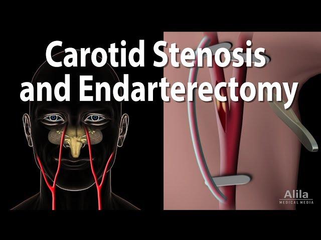 Carotid Stenosis and Carotid Endarterectomy, Animation