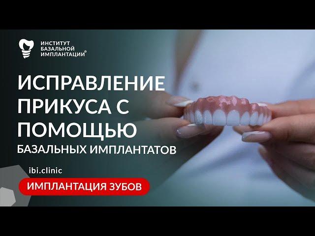 Исправление прикуса при помощи базальной имплантации | Лечение зубов