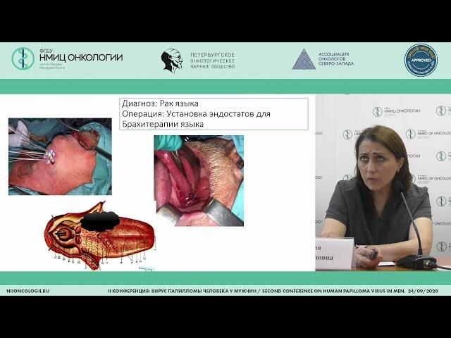 Modern treatment standards for squamous cell head and neck carcinoma (Zamira Radzhabova)