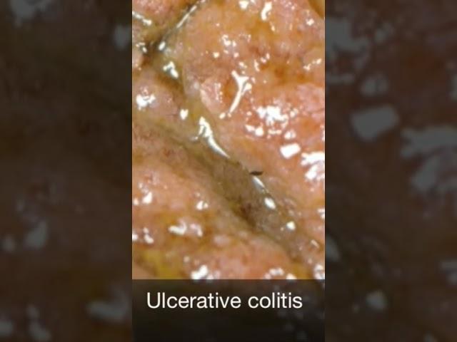 The gross appearance of ulcerative colitis