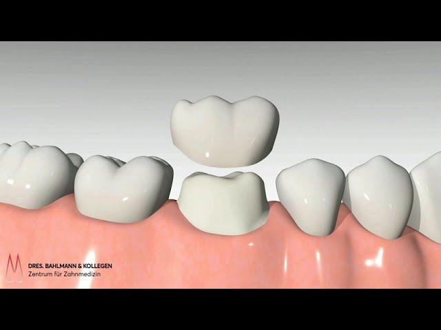 Zahnkrone Köln- Zahnmedizinische Krone (Ablauf)
