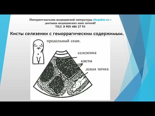 Кисты селезенки с геморрагическим содержимым.  Бесплатный медицинский журнал "МедДон".