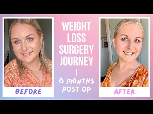 My Weight Loss Surgery Journey - 6 months Post Op Results - Costs, Diet Details and Complications