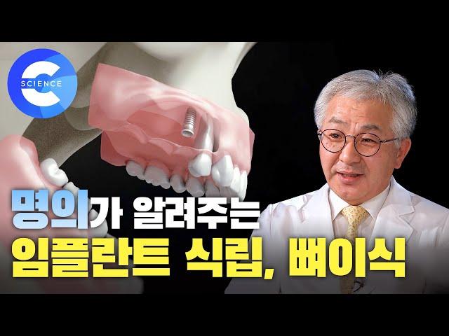 잇몸 질환은 왜 생길까? 임플란트 식립, 뼈이식 과정