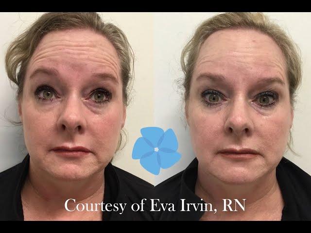 Neurotoxin Treatment | Nashville Injector