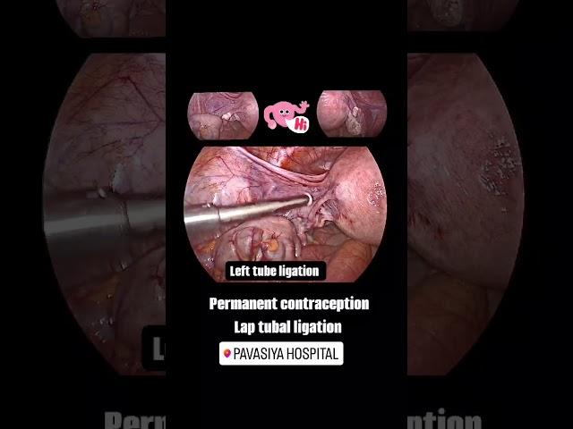 LAPROSCOPIC TUBAL LIGATION AT PAVASIYA HOSPITAL