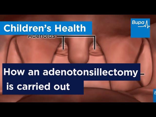 How an adenotonsillectomy is carried out | Bupa Health