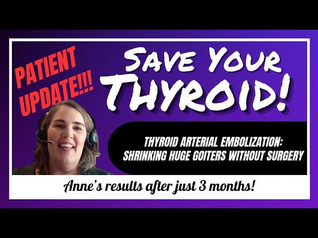 Shrinking a HUGE goiter without surgery?! Anne's update