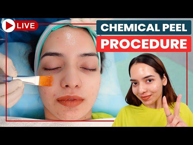 CHEMICAL PEELS -Step by Step | Acne Scar Treatment in Delhi | Chemical Peeling Treatment| Dr Jangid