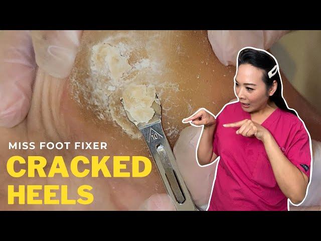 CRACKED Heels No More I Miss Foot Fixer