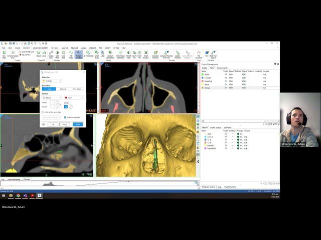 Materialise Mimics Quickstart Segmentation Skull