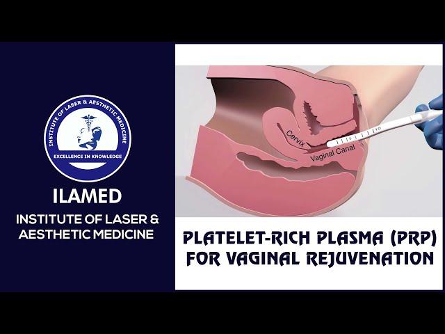 Platelet-rich plasma (PRP) for Vaginal Rejuvenation