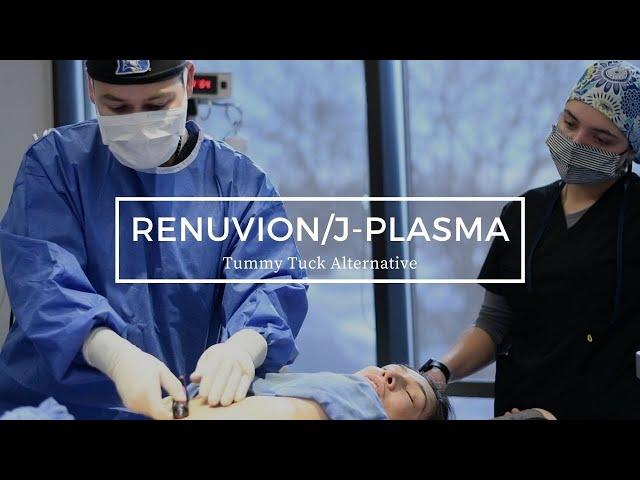 Renuvion/J-Plasma - Tummy Tuck Alternative?