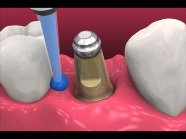 Smyl Manatee - Dental Implant Procedure