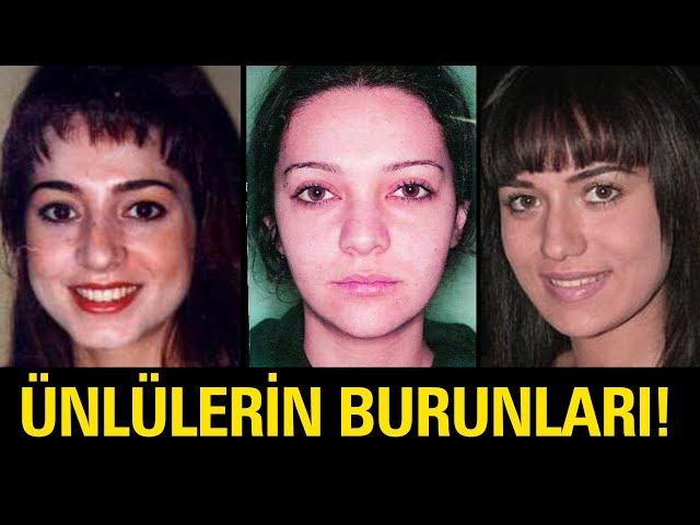 İyi ki Burun Estetiği Olmuş Diyeceğiniz 20 Türk Ünlü