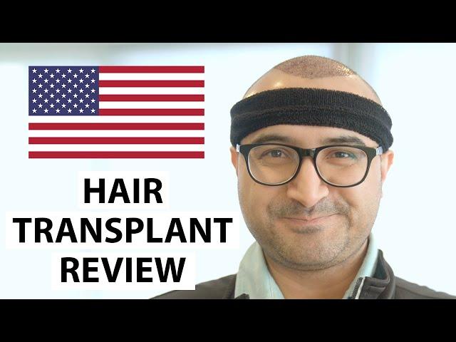 HELLO USA! Arslan's Hair Transplant Experience at AEK Hair Clinic