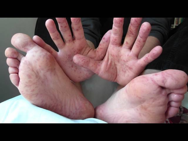 Spotting Hand, Foot & Mouth Disease