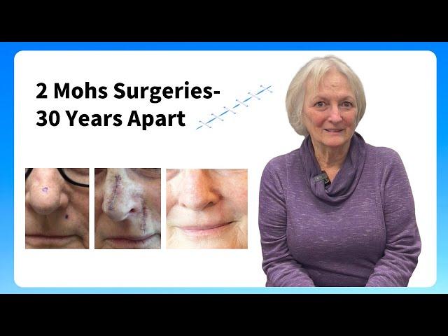 Mohs Surgeries 30 years apart for skin cancer patient