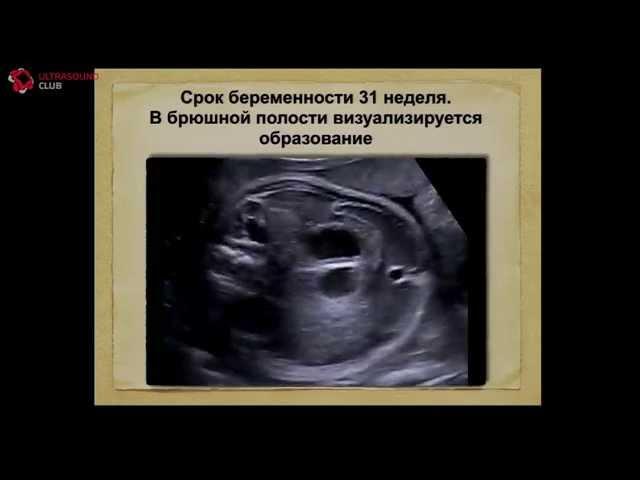 Пренатальная диагностика аноректальной атрезии: как количество переходит в качество - А.Ю. Блинов